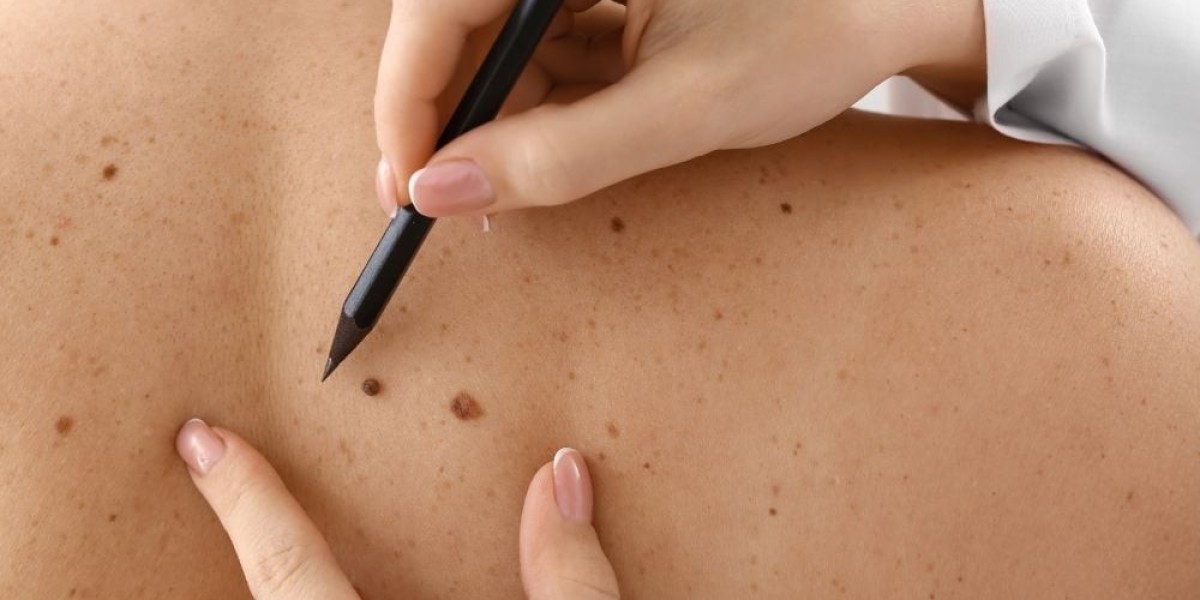 Which Warts Removal Treatments Are Best for Clustered Warts?