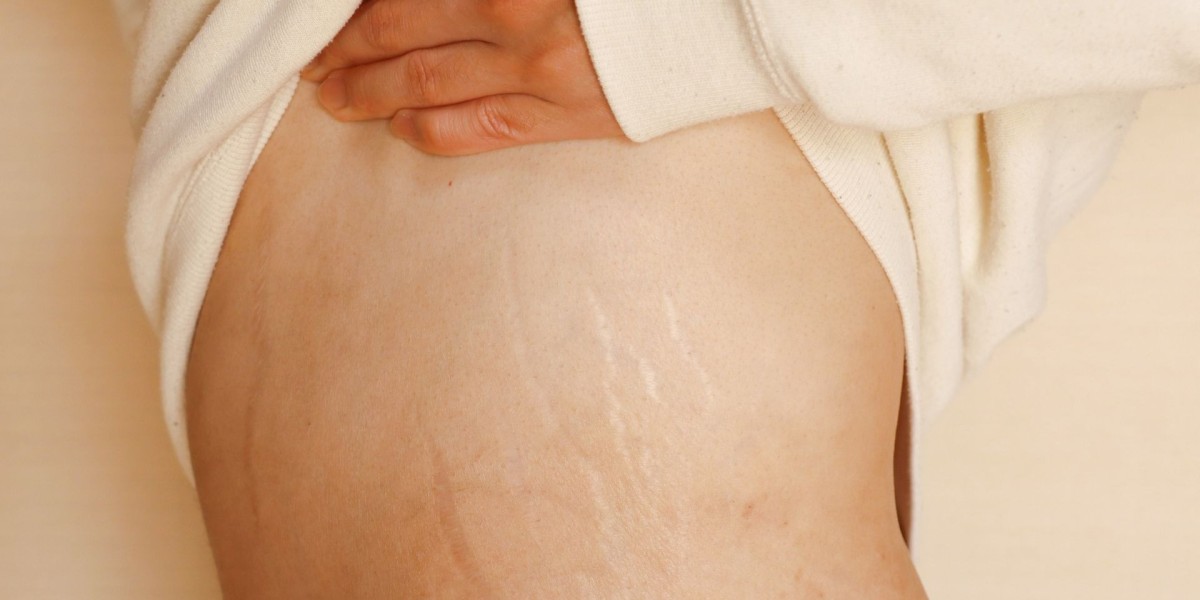 How fast is laser stretch mark removal Dubai?