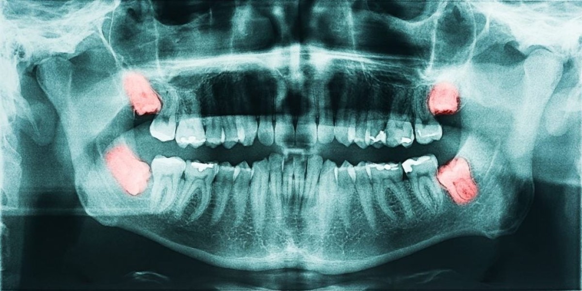 Is It Smart to Delay Because of Panoramic Dental X-Ray Cost?