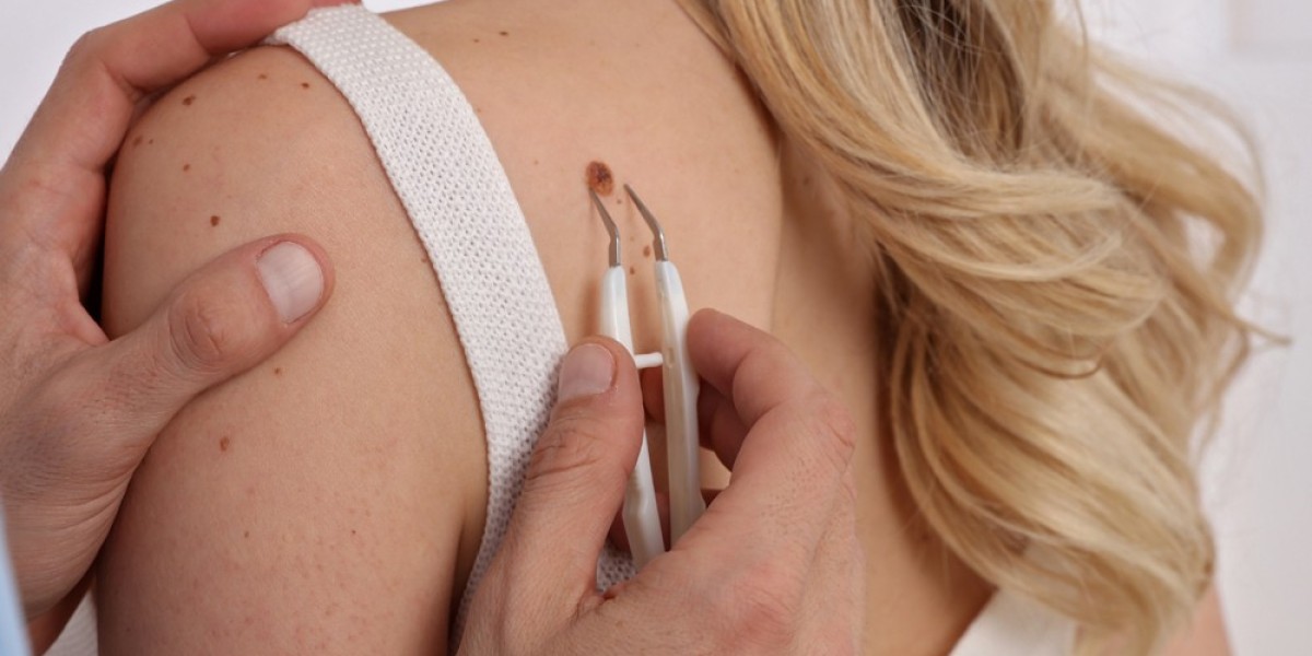 Cost of Skin Tag Removal in Islamabad