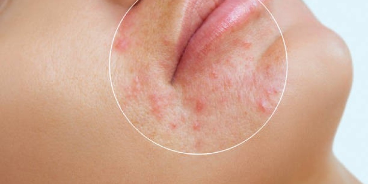 Clearer Skin Ahead with Laser Acne Scar Treatment Tips