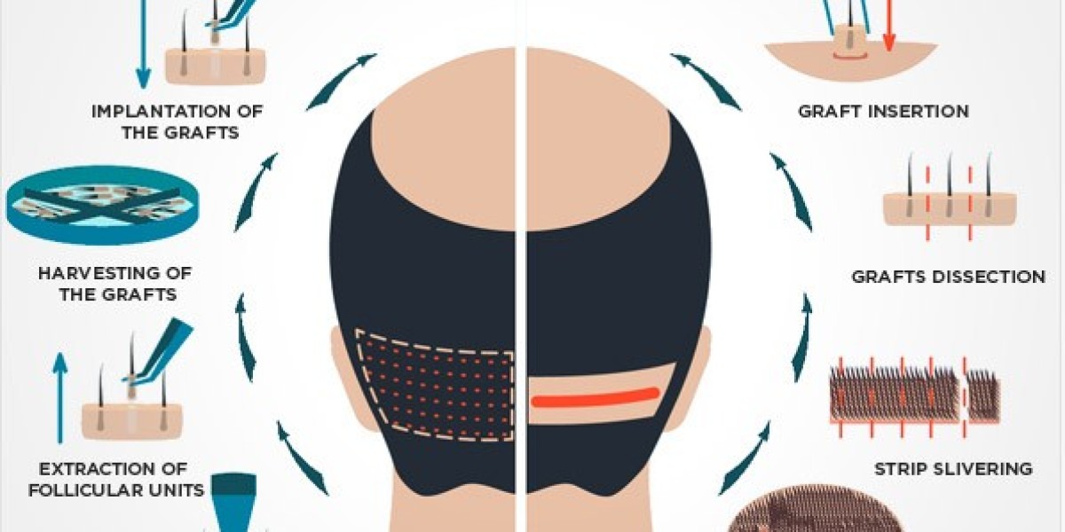 Skilled Hair Transplant Surgeon in Delhi