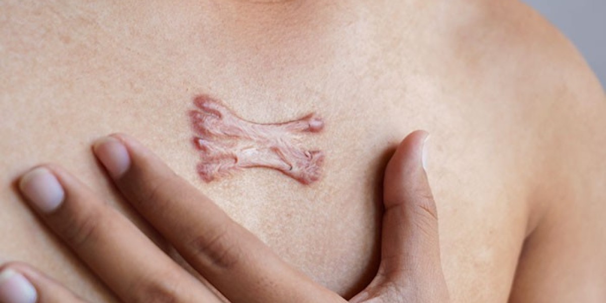 Keloid Removal Without Surgery: Non-Invasive Options