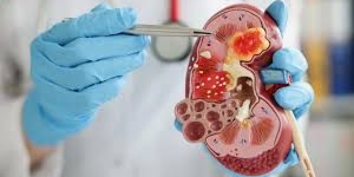 Kidney Stone Laser Treatment and Choosing the Right Hospital