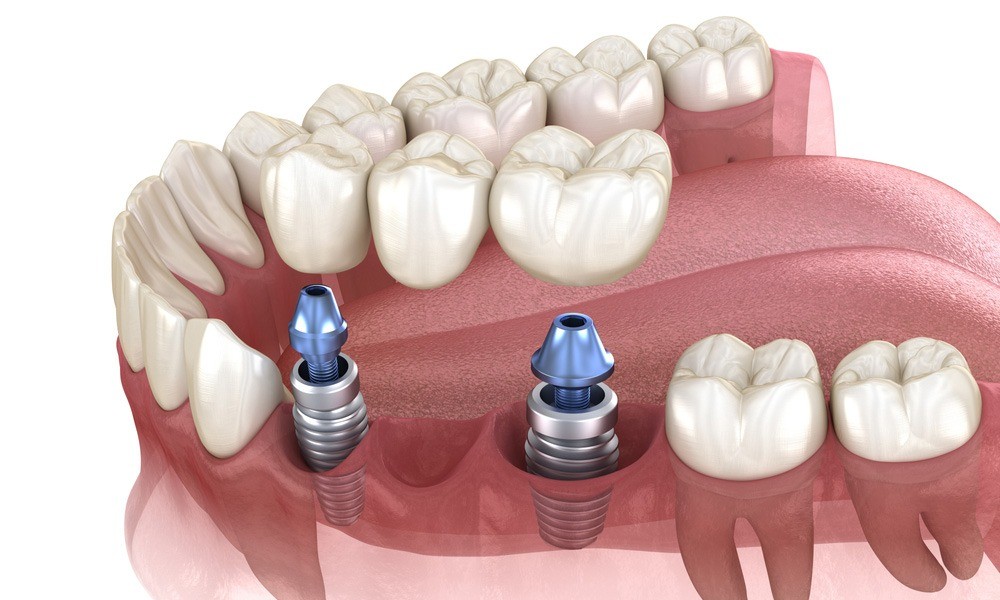 Dental Crowns and Bridges