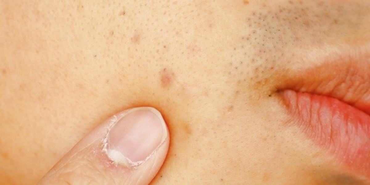 How Do Chemical Peels Help With Acne Scar Treatment?