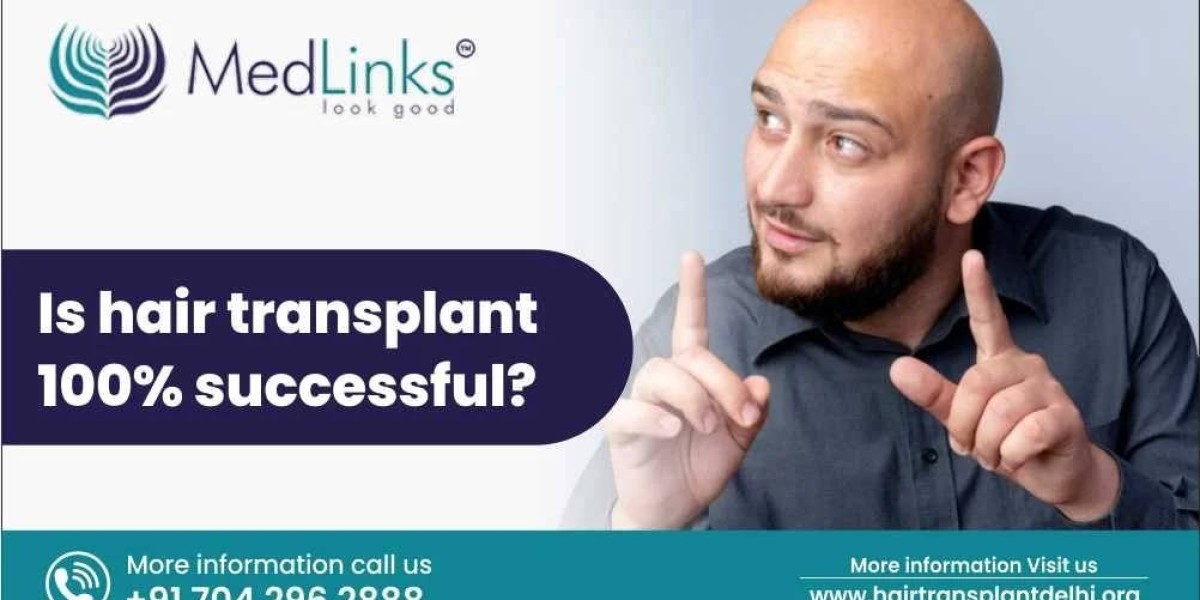 Is Hair Transplant 100% Successful? — Exploring the Truth