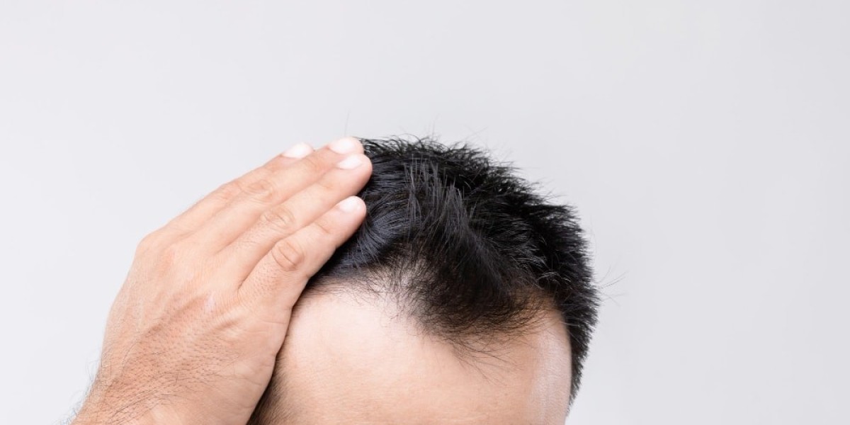Is Hair Transplant Suitable for Every Type of Hair Loss?