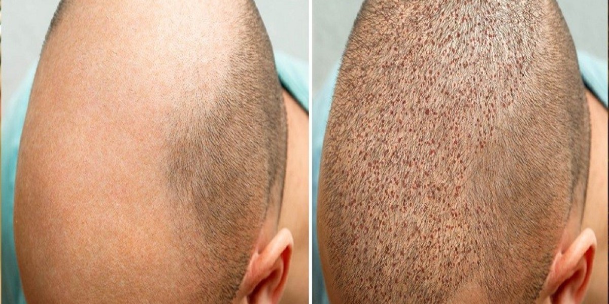 Concierge-Level Care for Hair Transplants in Dubai