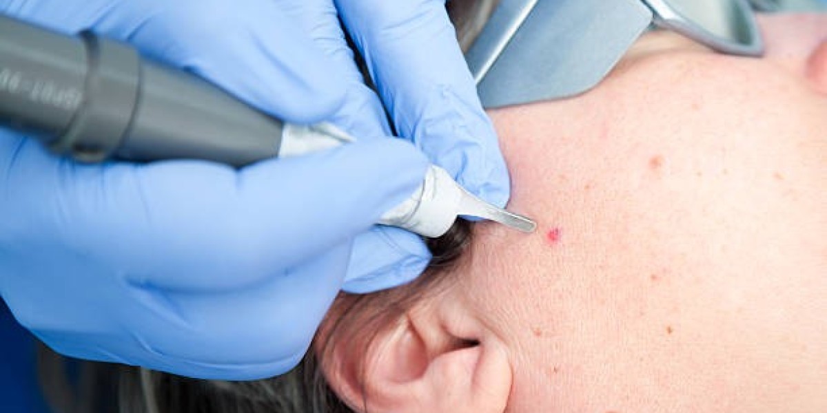 Mole Removal: How to Spot Dangerous Moles at Home