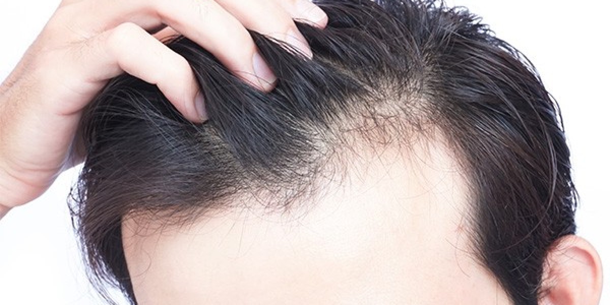 Can Robotic Hair Transplant Stop Hair Loss Permanently?