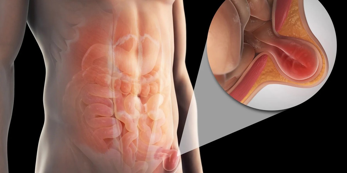 The Complex Hernia: What Does It Mean? How is it treated?