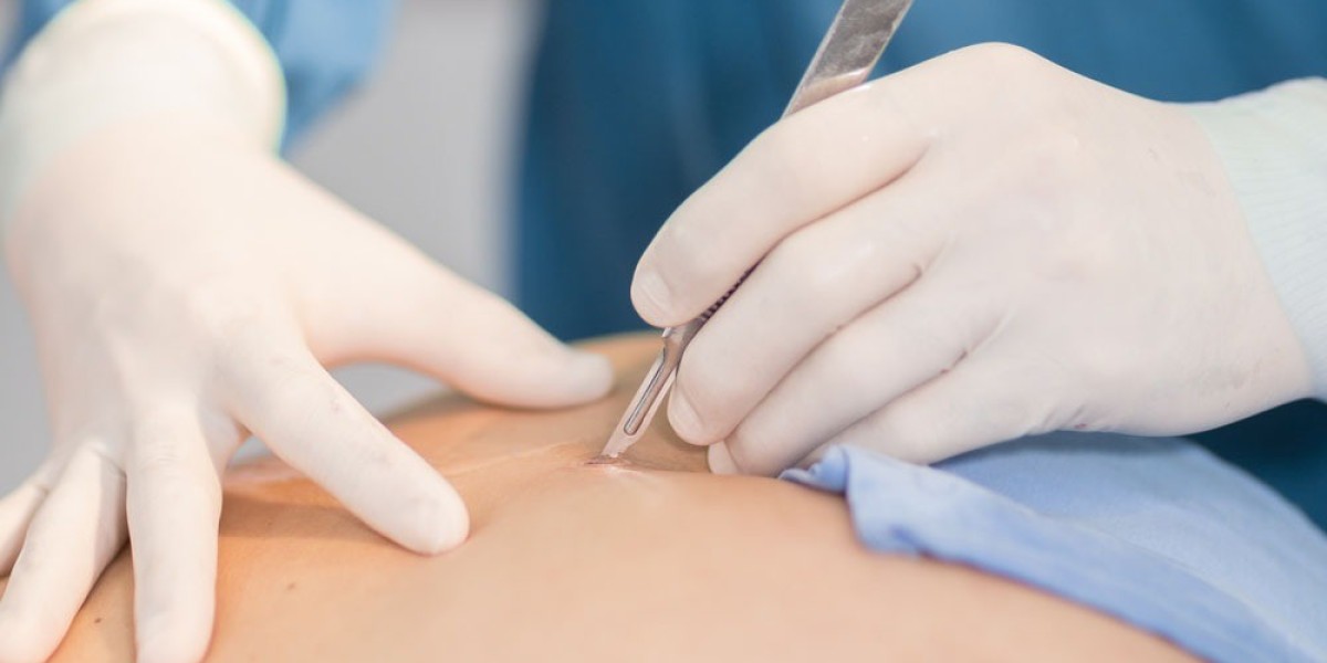 How Much Should You Expect to Pay for Wart Removal?