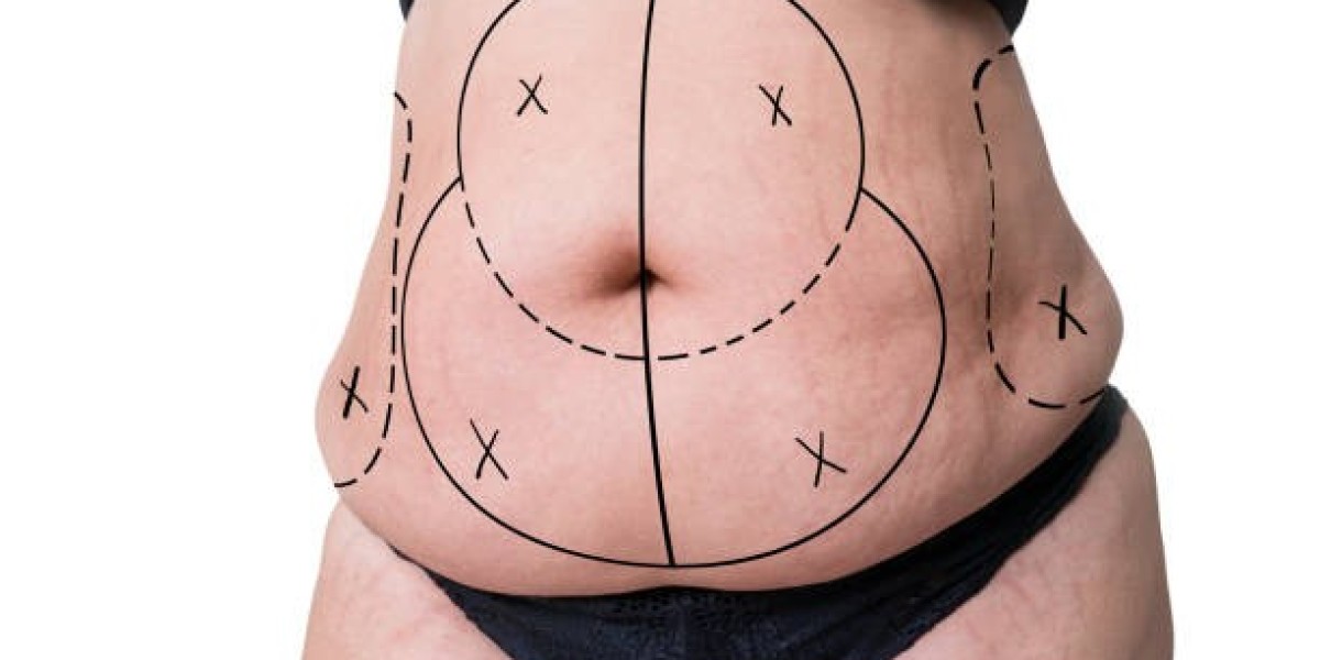 What to Expect During Your Lipo Abdominoplasty Procedure