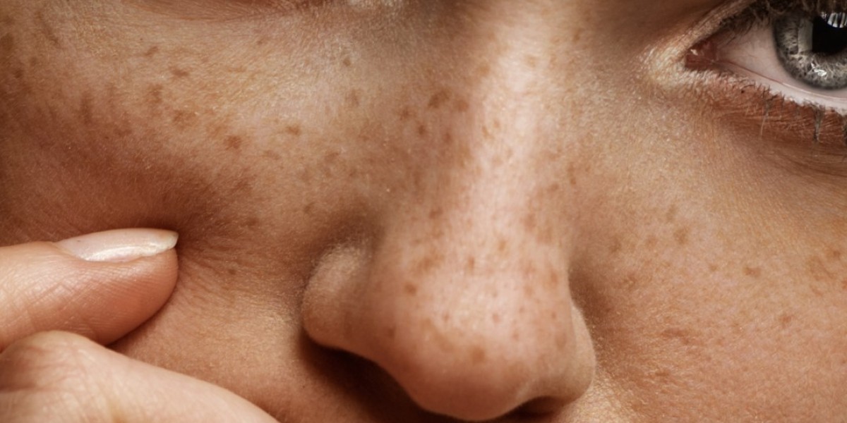 What Are the Types of Skin Pigmentation?