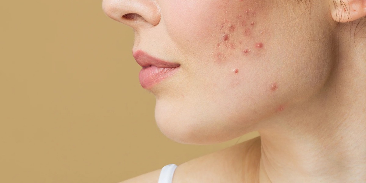 How Do Chemical Peels Help With Acne Scar Treatment?