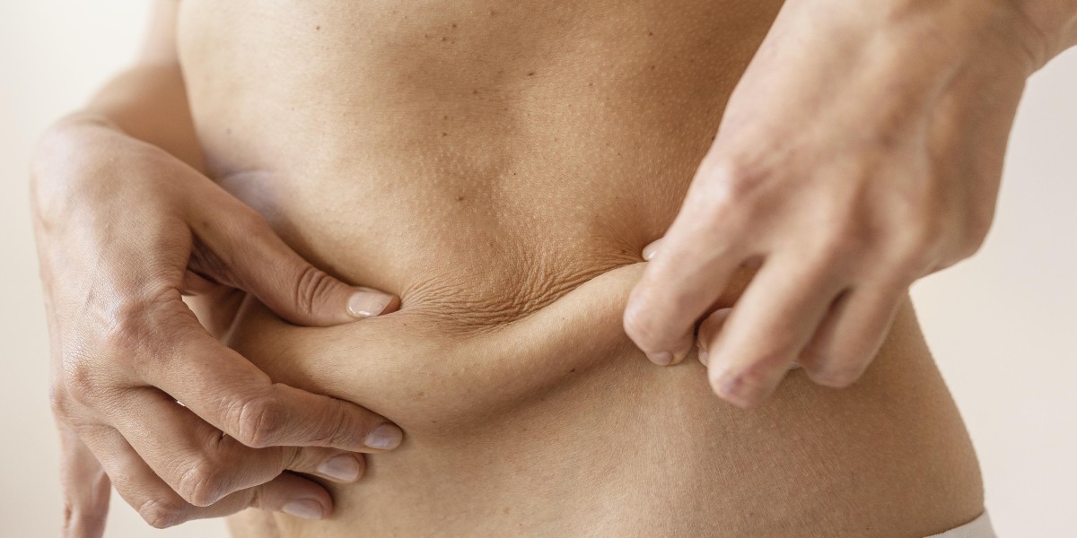 What Tummy Tuck Techniques Are Commonly Used?