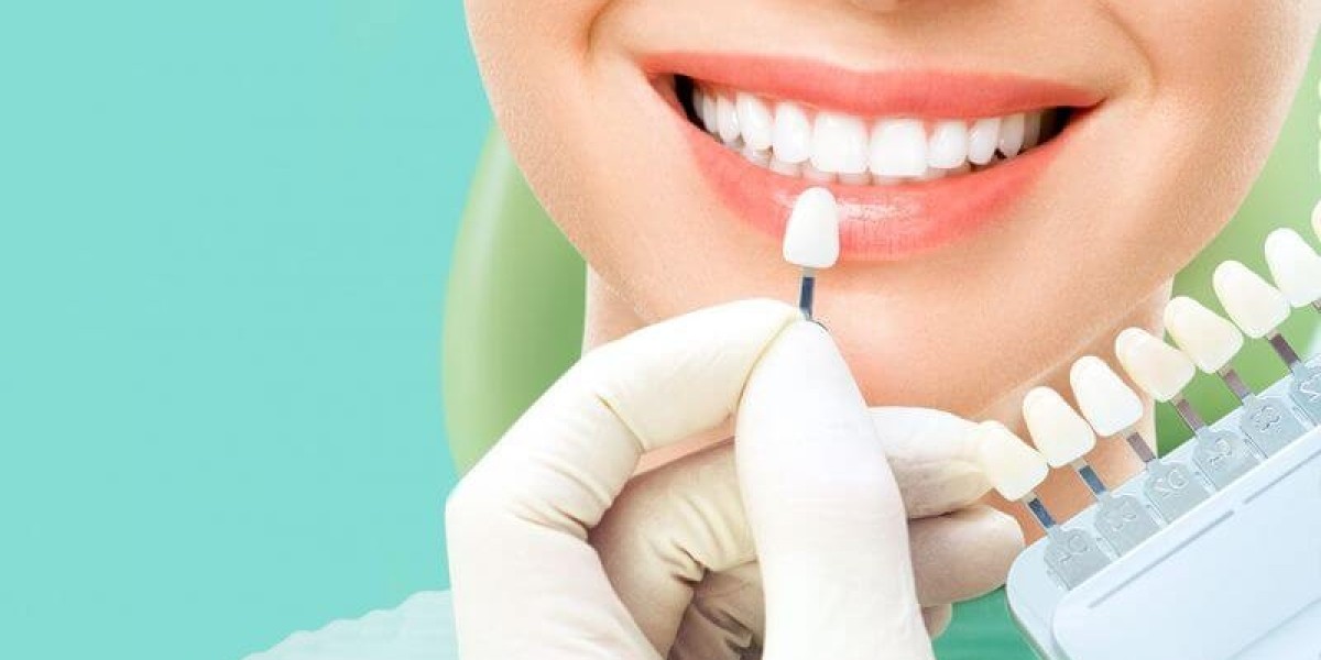 Longevity of Dental Veneers: How Long Do They Last?