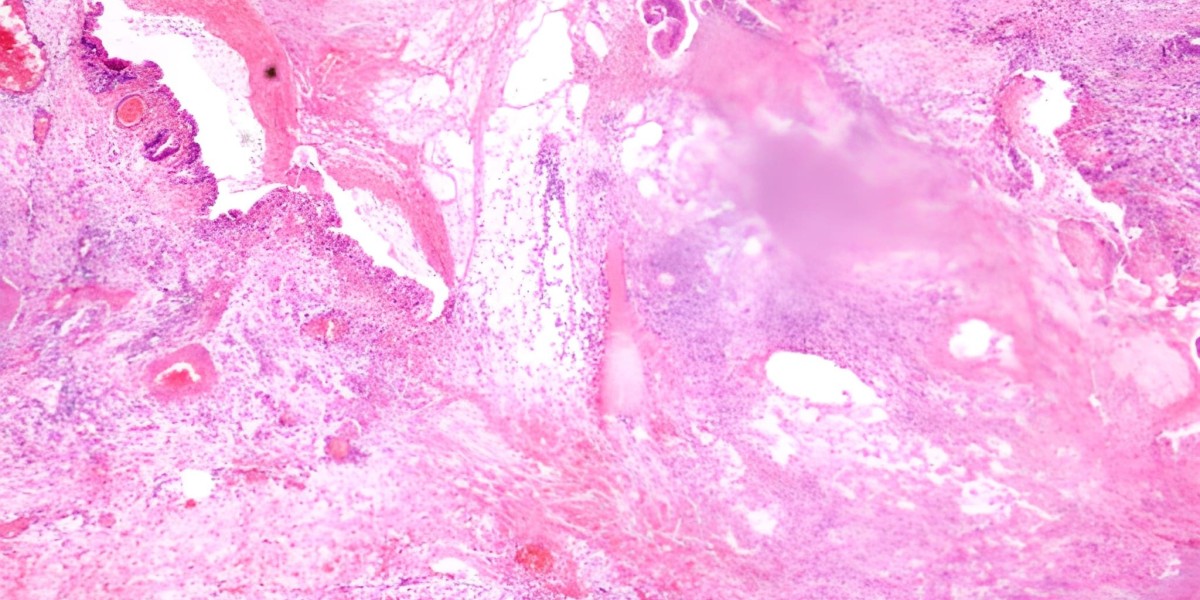 Innovations in B‐Rapidly Accelerated Fibrosarcoma Therapy: Market Trends and Future Outlook