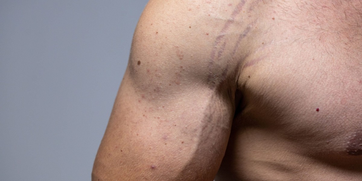 Can Men Also Benefit from Stretch Marks Removal Treatments?