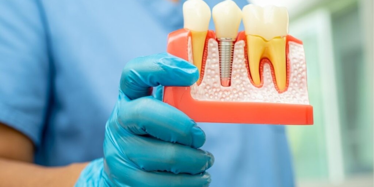 Smile Like Royalty: How Crowns and Bridges Can Transform Your Teeth