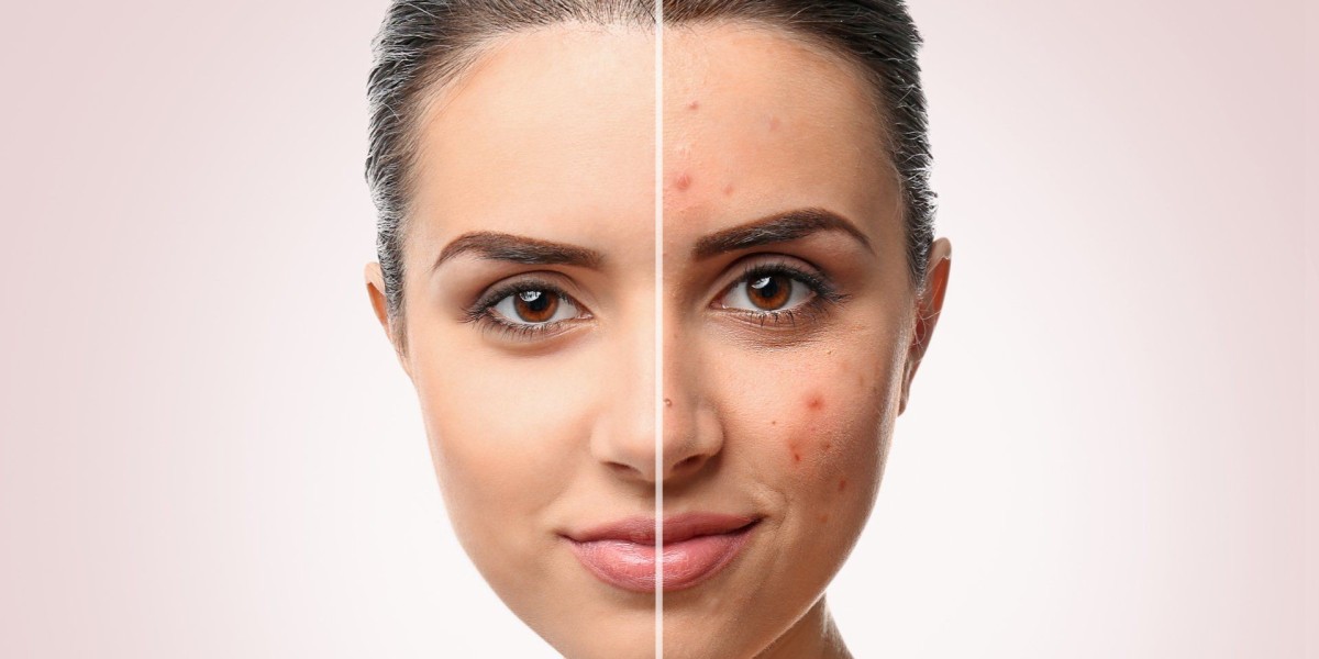 Tips for Getting the Best Value on Laser Scar Removal Cost in Dubai