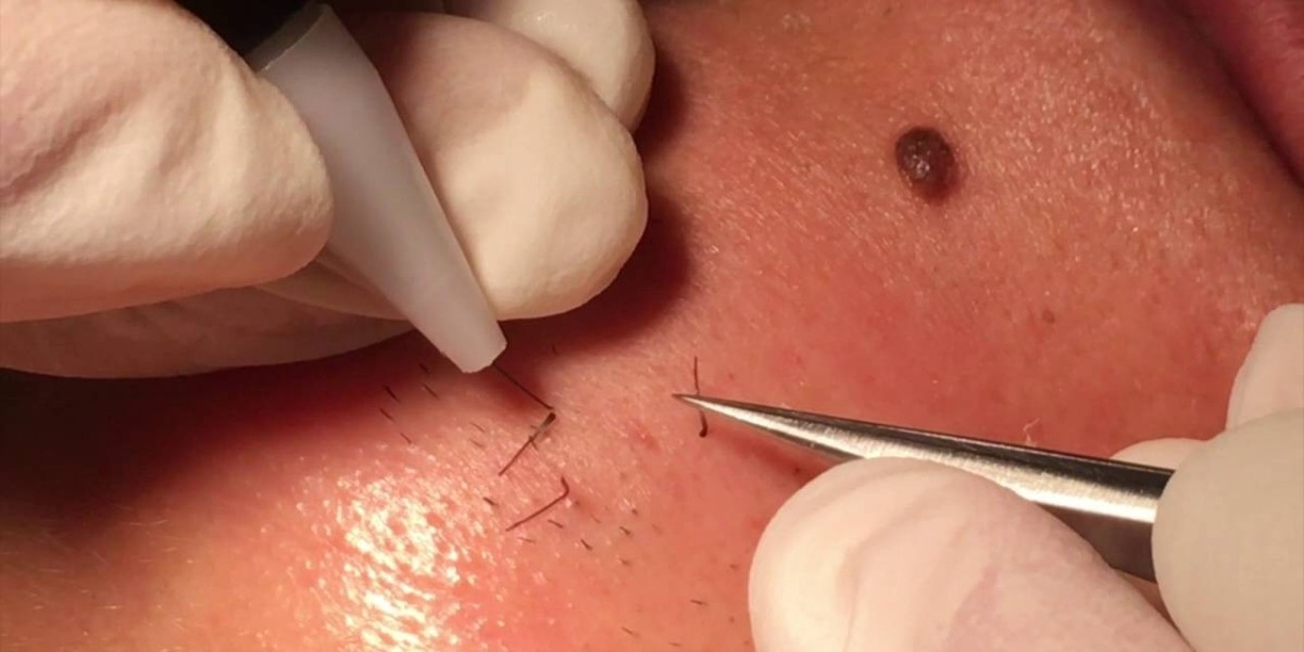 What Is Electrolysis Hair Removal and How It Works?