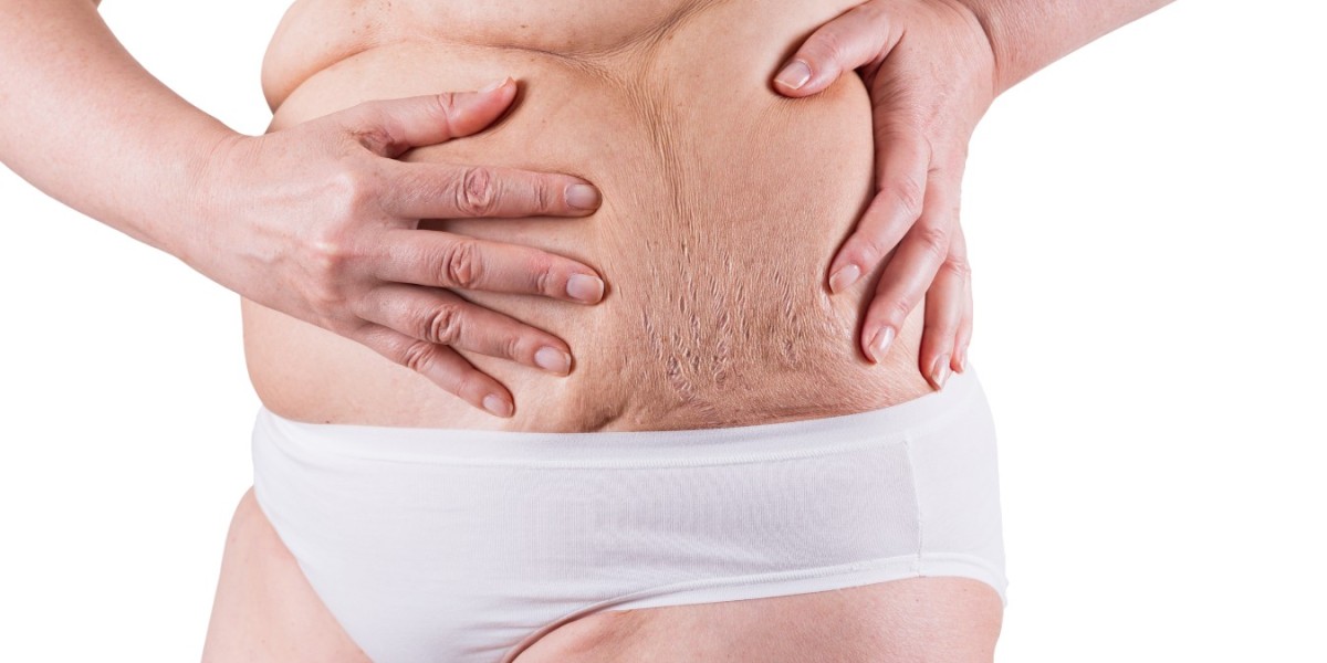 How Tummy Tuck for Weight Loss Restores Natural Contours?
