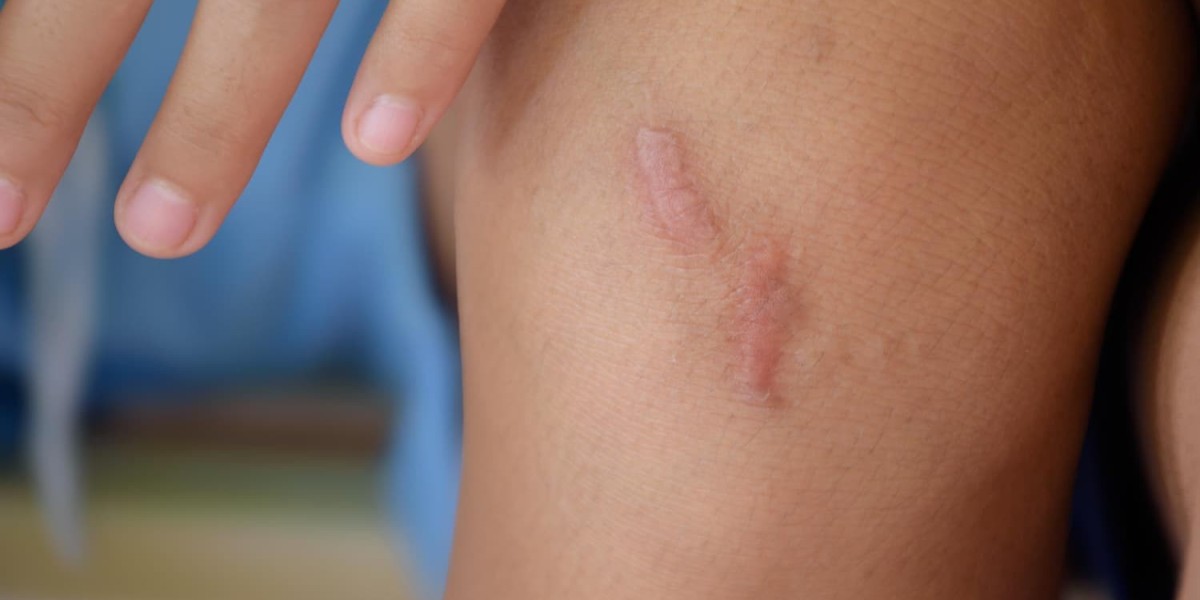 Do Keloid Treatments Help in Reducing Pigmentation or Dark Marks?