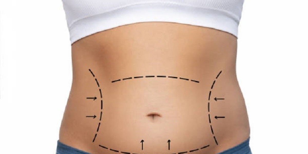 From Consultation to Recovery: Your Lipo Abdominoplasty Journey in Riyadh