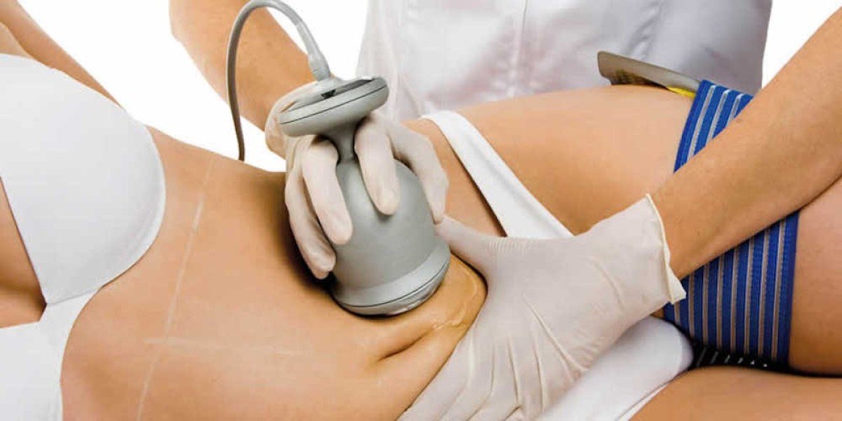 Can Ultrasound Cavitation Effectively Target Stubborn Belly Fat?