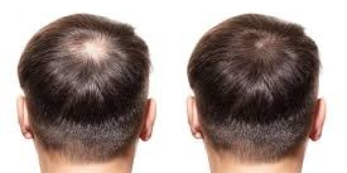 Is GFC Treatment in Dubai Painful or Comfortable in Dubai UAE At Glamorous Clinic ?