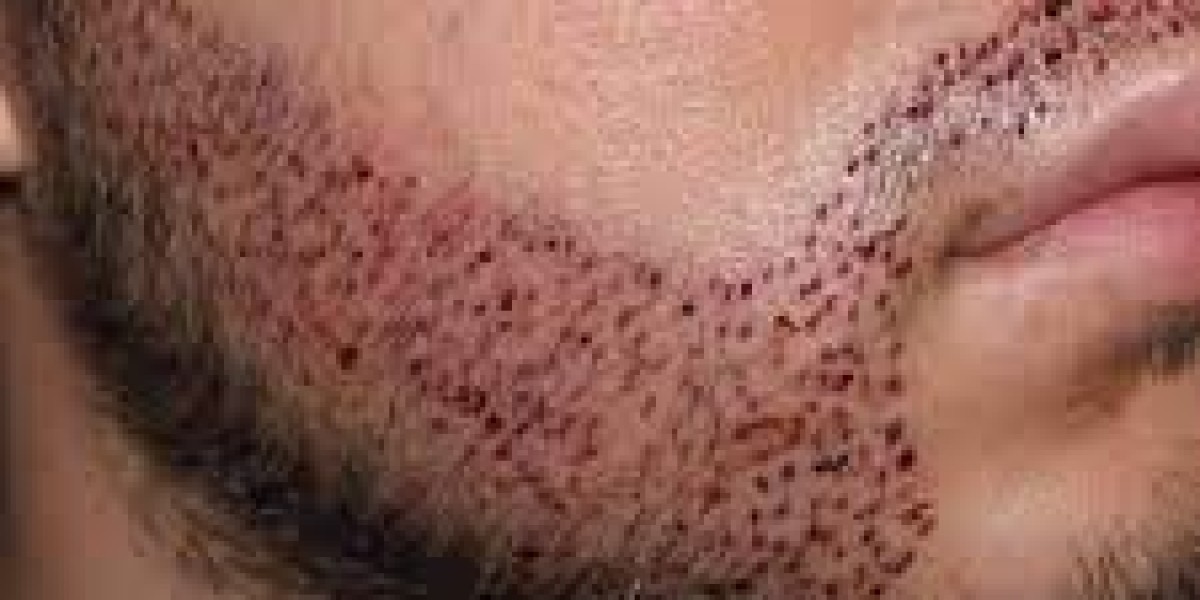 Can Beard Hair Transplant Fix a Patchy Beard Fast?