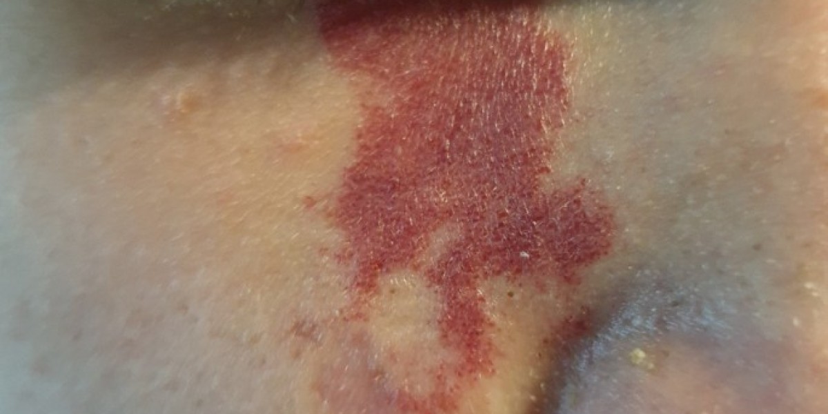 Does IPL Therapy Work Well for Port Wine Stain Removal?