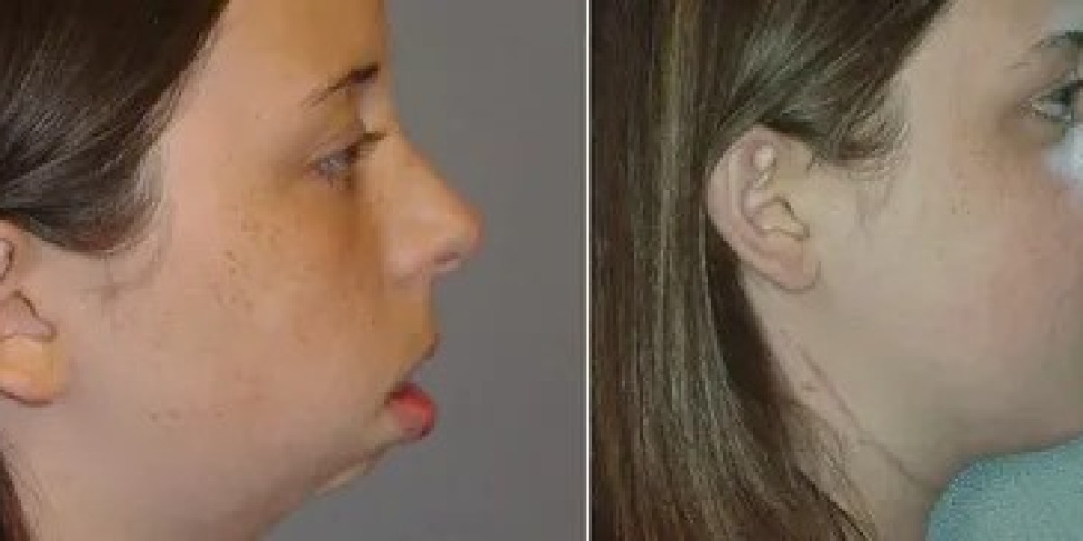 Finding the Best Price for Jaw Surgery in Islamabad