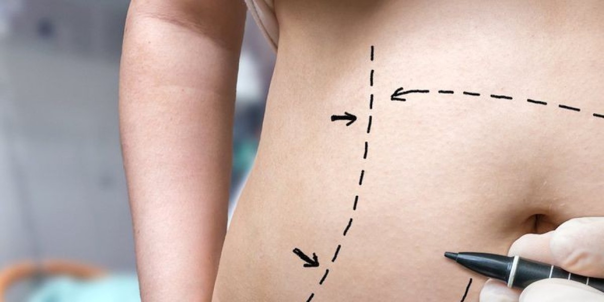 Is a Tummy Tuck Safe for Weight Loss Goals?