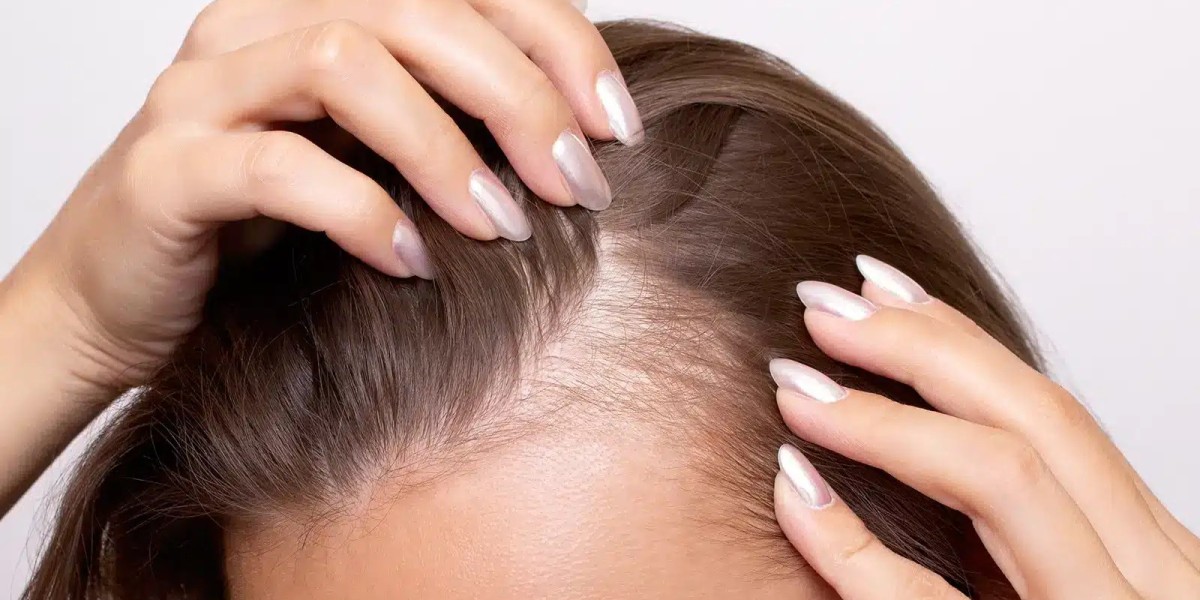 Which Hair Loss Treatments Are Best for Men and Women?