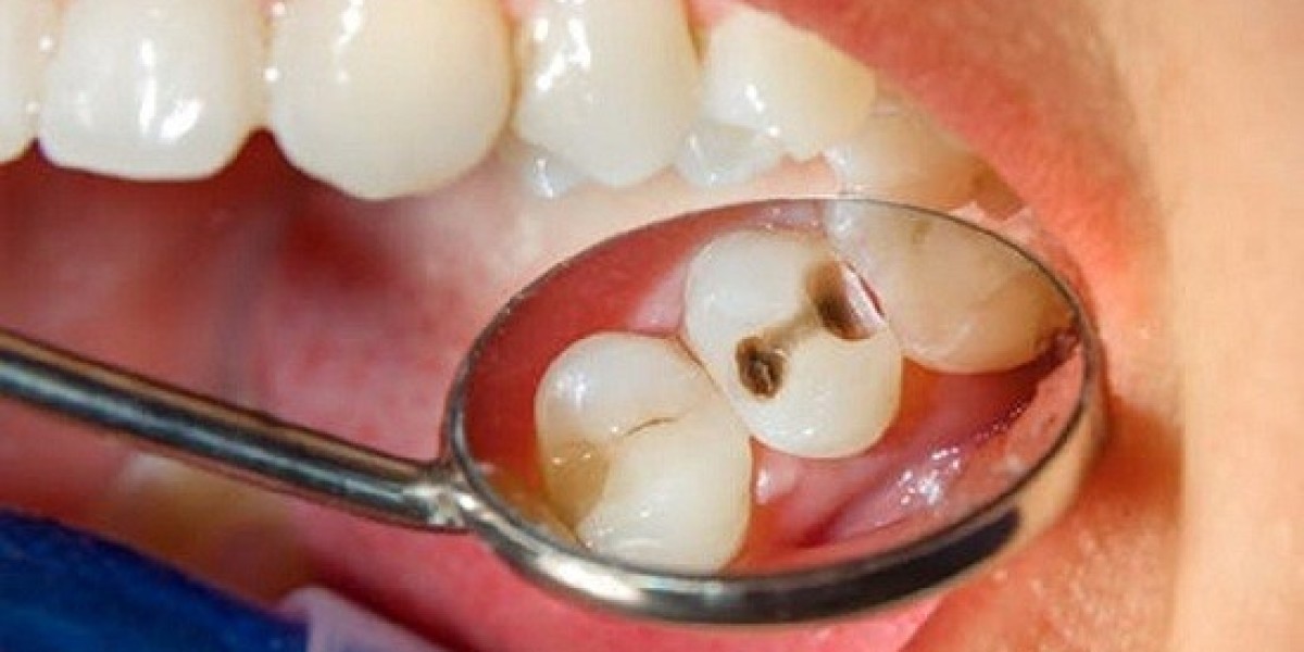 Trám răng đúng cách: Đừng để lỗ sâu nhỏ trở thành vấn đề lớn