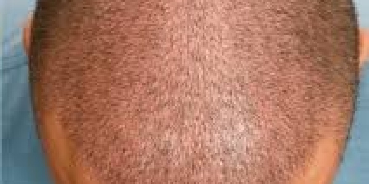 What Can You Get for 499 AED in Hair Restoration in Dubai UAE ?