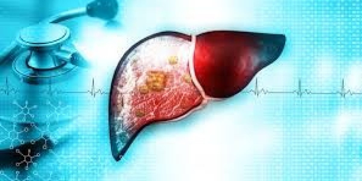 Chronic Liver Disease Treatment: Complete Care for Better Health