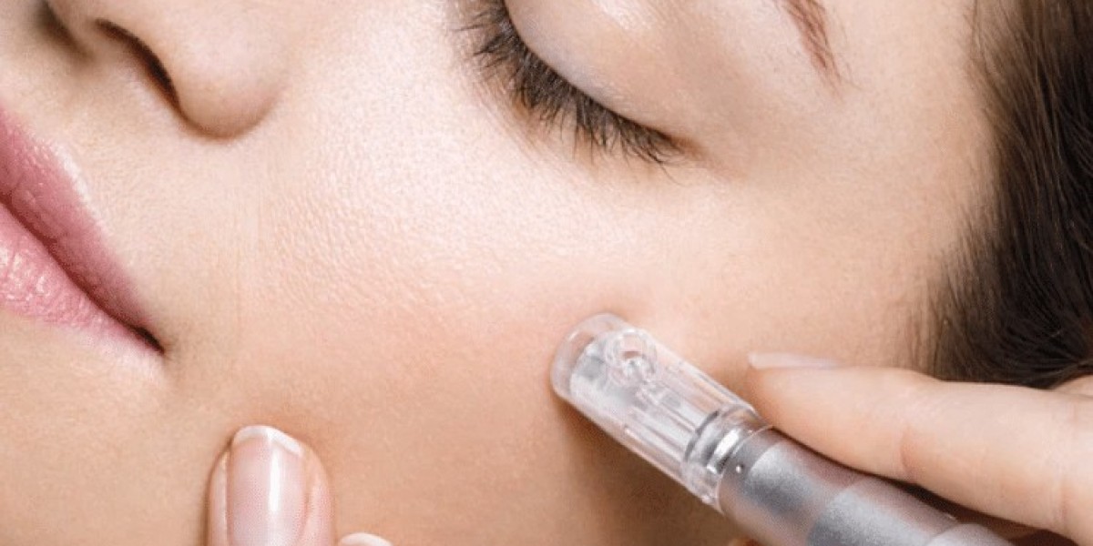 What Are the Advantages of Microneedling?