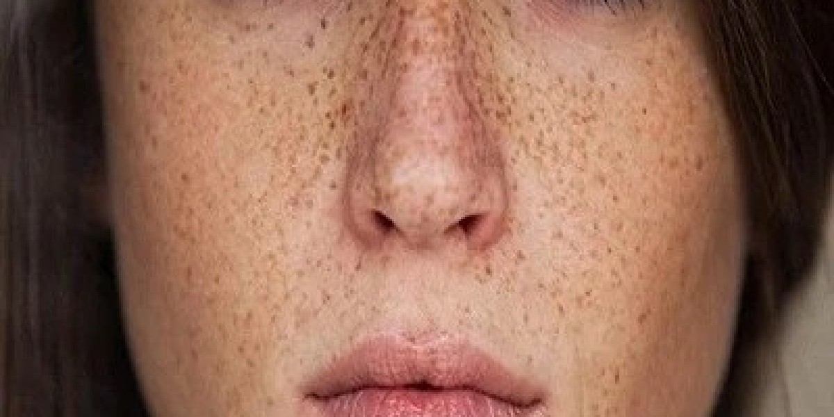 Are Freckles And Blemishes The Same?