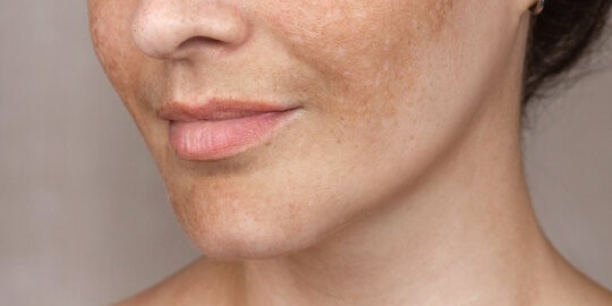 Cost vs. Results: Melasma Treatment in Islamabad