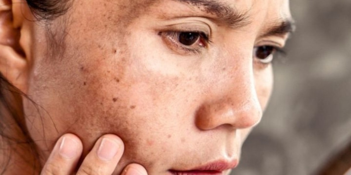 Is It Possible to Permanently Get Rid of Freckles and Blemishes?
