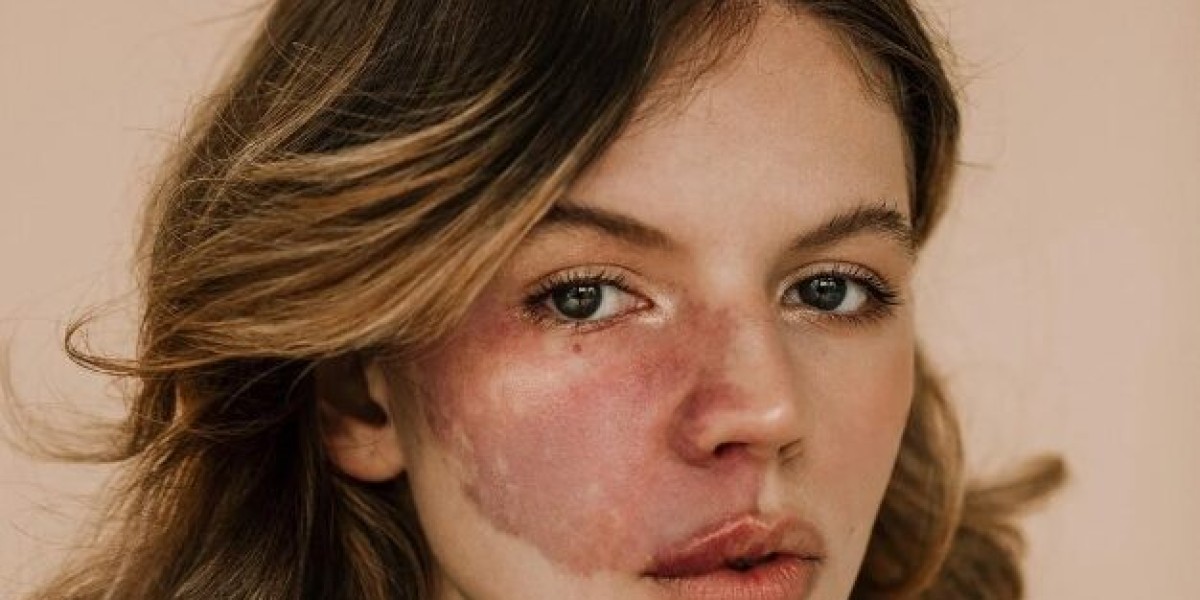 What Are the Most Effective Medical Treatments for Port Wine Stains?