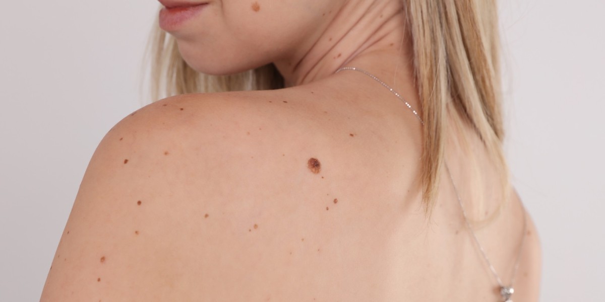 Real Stories: Life After Birthmark Removal in Dubai