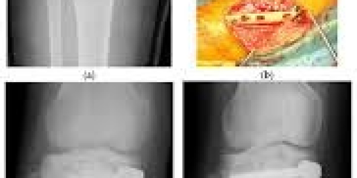 Bone Regeneration Market Developments in Regenerative Medicine and Orthopedics
