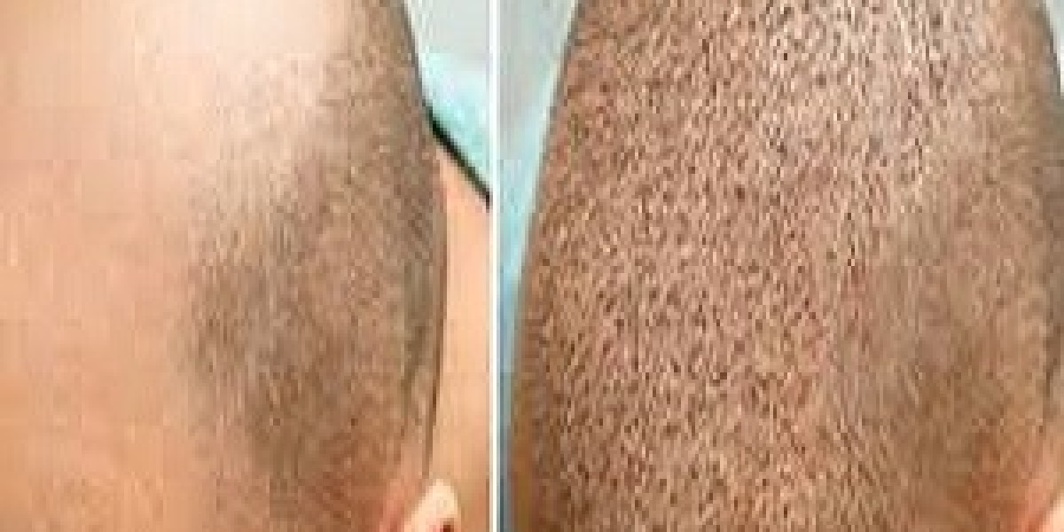 The Definitive Guide to Hair Transplants in Riyadh