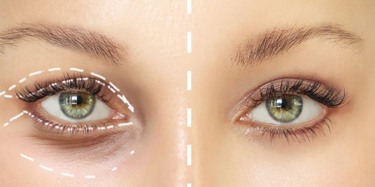 Risks and Complications: What to Know About Eyelid Surgery in Riyadh