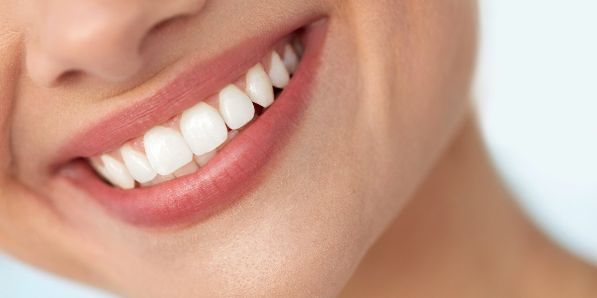 Veneers Dubai: Achieving the Perfect Hollywood Smile